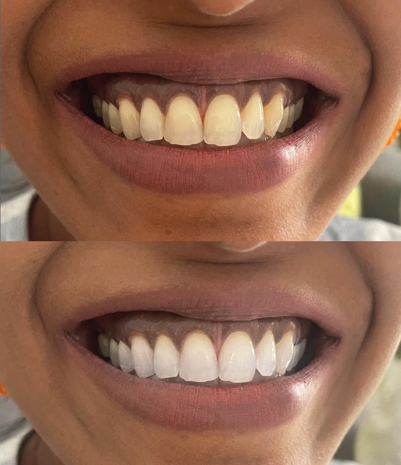 Dental Professional Teeth Whitening Strips